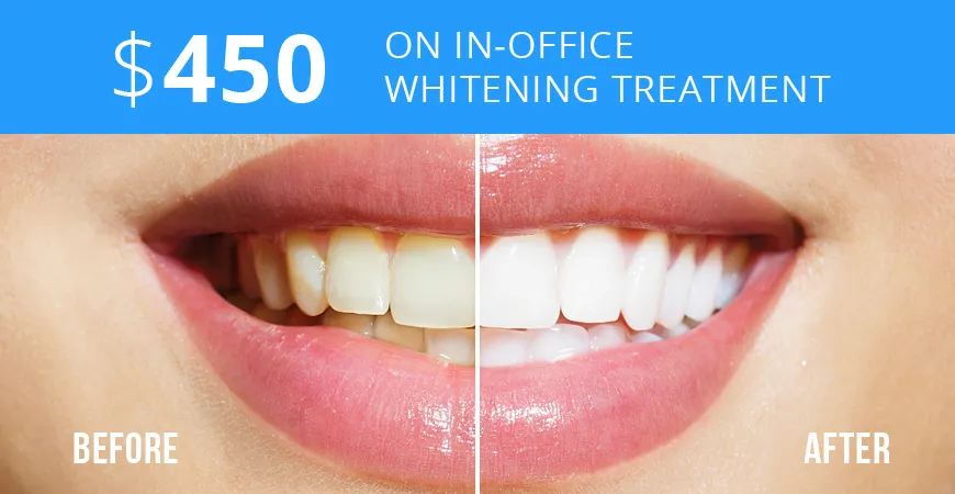 29355 in office teeth whitening