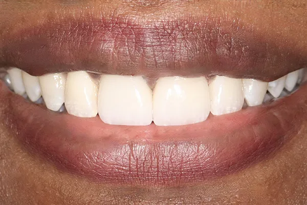 29361 at home teeth whitening pearland