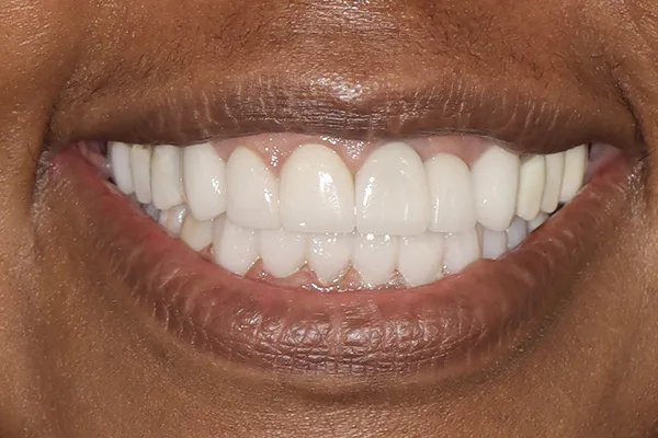29361 best dentist teeth whitening pearland