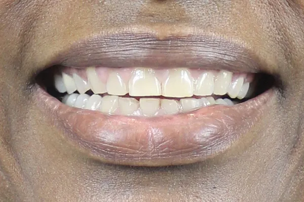 /img/29361-maintaining-teeth-whitening-pearland.webp
