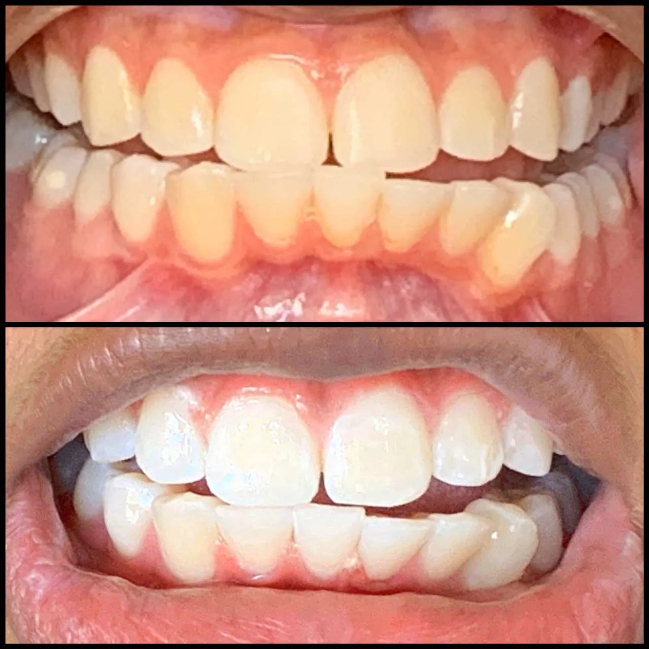 29364 teeth whitening hanford ca image5