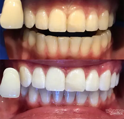 29372 zoom teeth whitening long island maintenance
