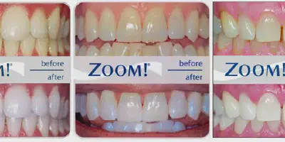 /img/29372-zoom-teeth-whitening-long-island-professional.webp
