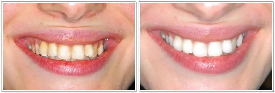 29372 zoom teeth whitening long island smile