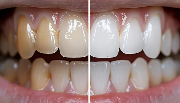 29375 at home teeth whitening kits