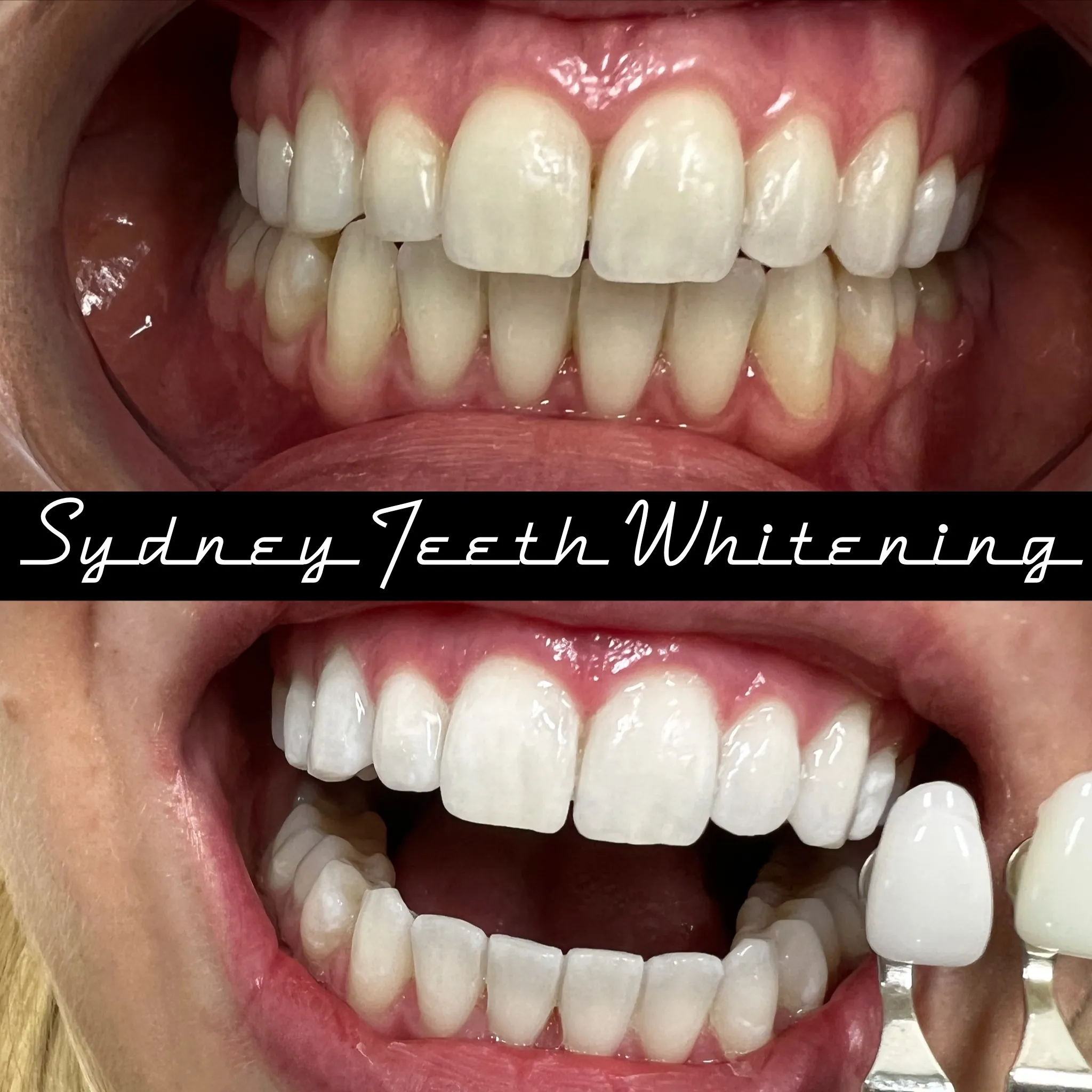 29375 teeth whitening diet