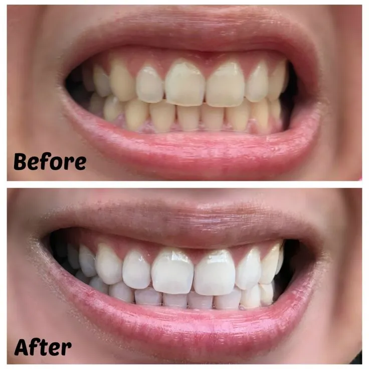 29375 teeth whitening sensitivity