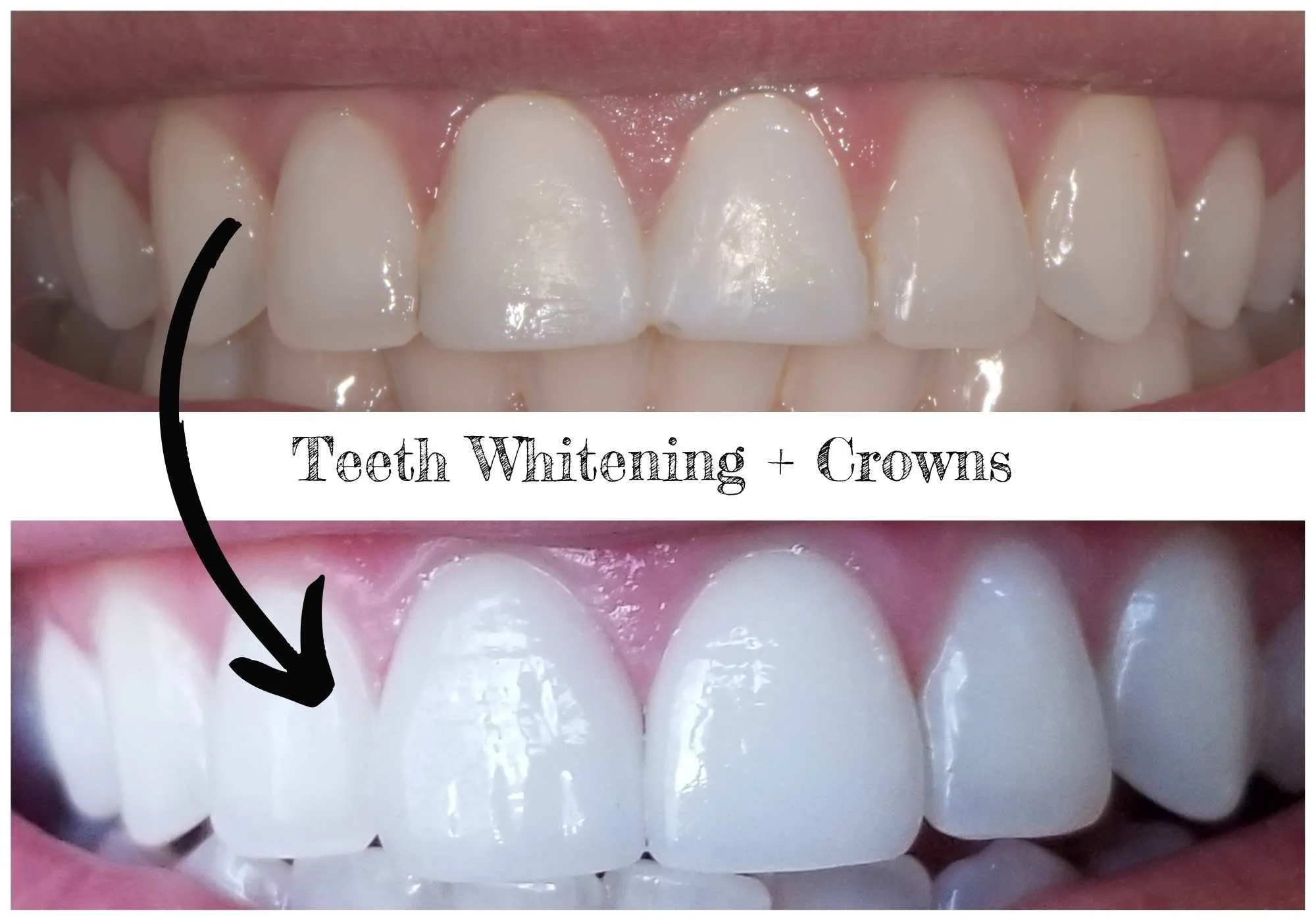 29383 in office whitening