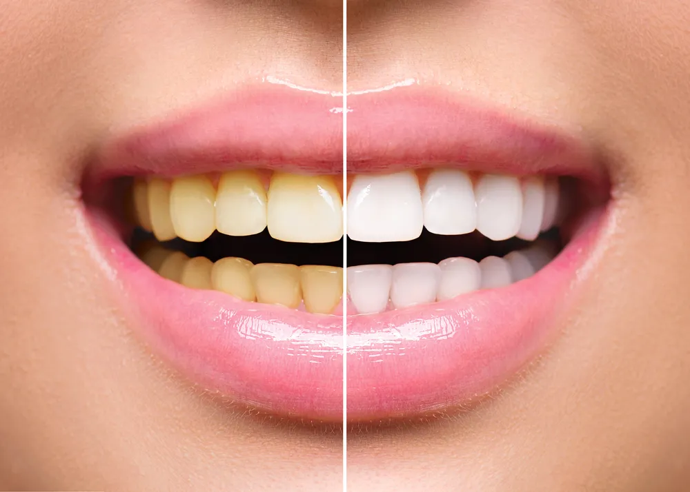 29383 teeth whitening options