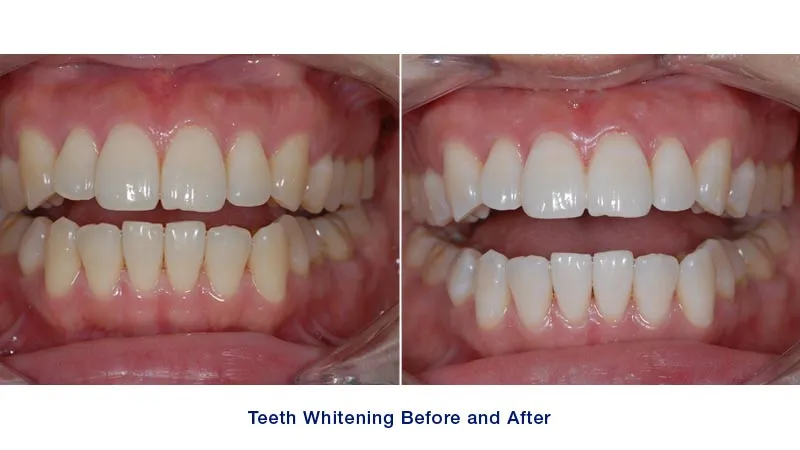 29387 at home teeth whitening kits