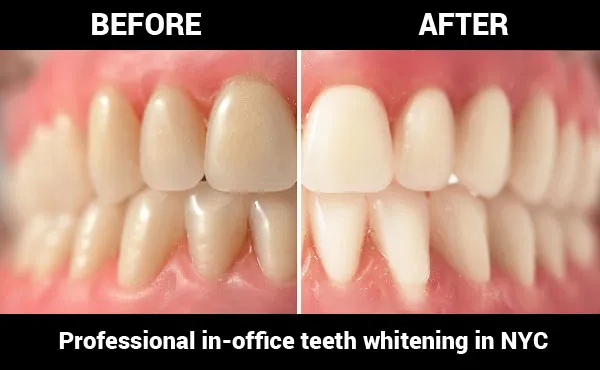 29387 factors influencing teeth whitening cost