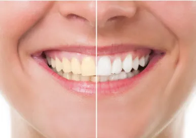 29387 in office teeth whitening