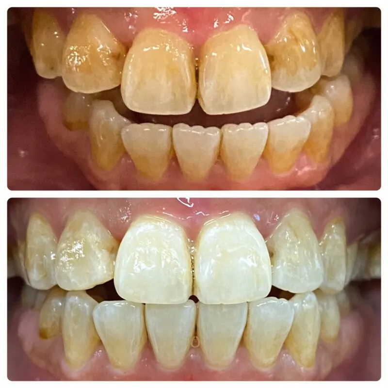 29389 teeth whitening diet