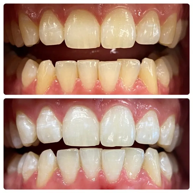 29389 teeth whitening process