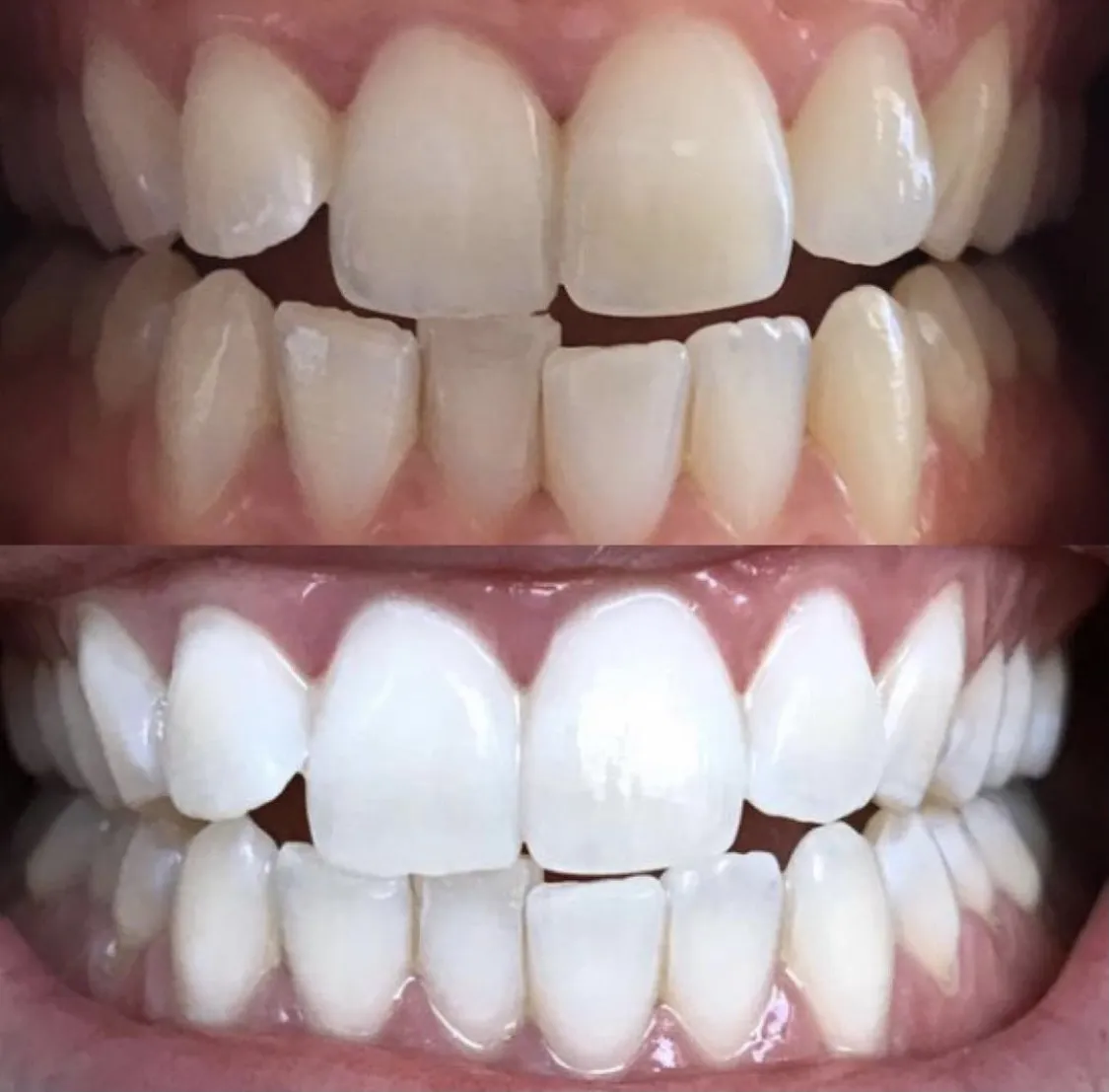 29389 types of teeth whitening