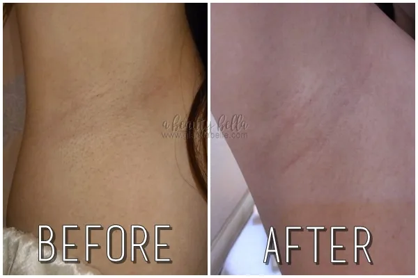 29390 comparing whitening methods