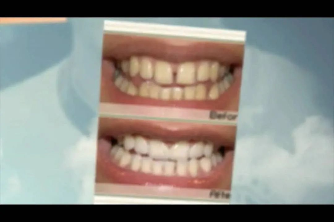 29395 teeth whitening worcester ma teeth condition