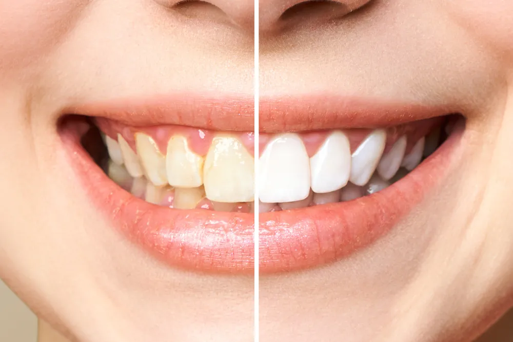 29395 teeth whitening worcester ma toothpaste