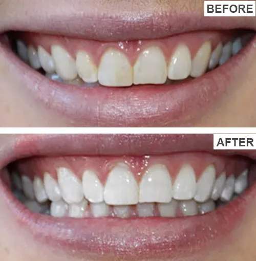 29401 teeth whitening aftercare image4