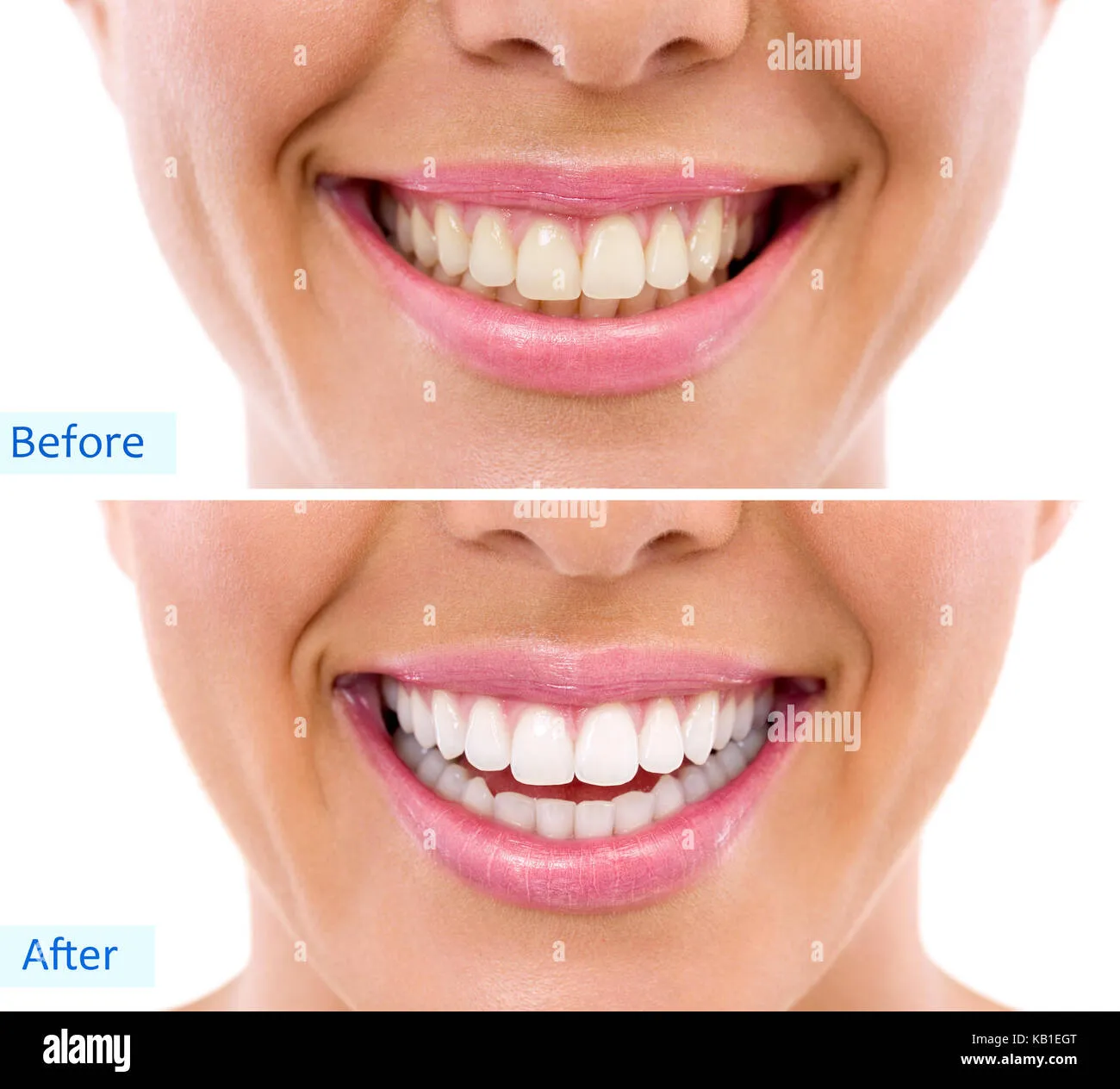 29401 teeth whitening aftercare image5