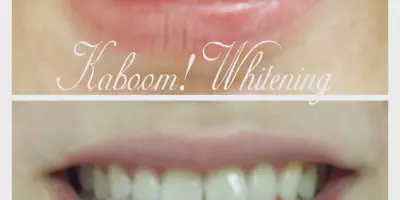 /img/29401-teeth-whitening-aftercare-image7.webp