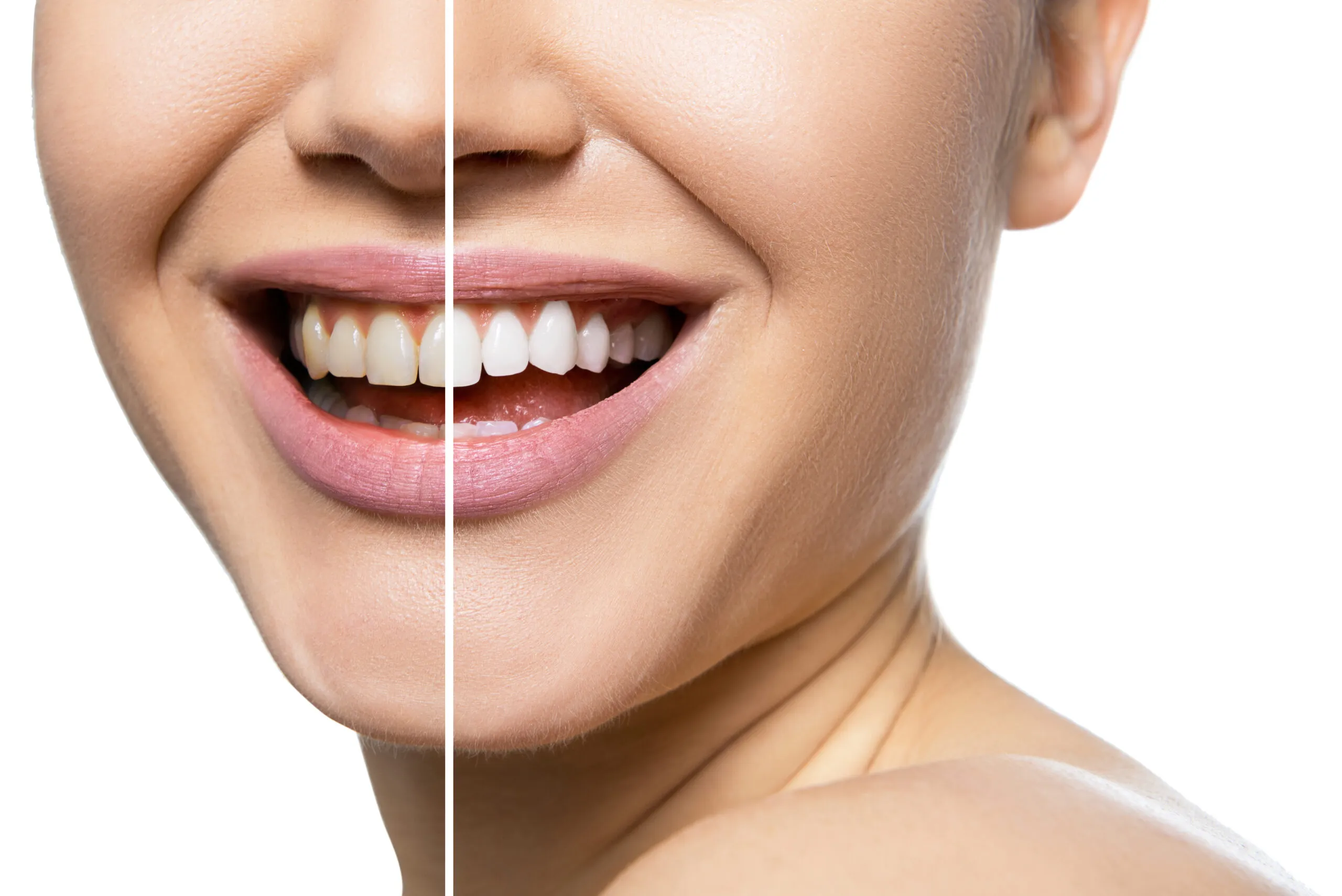 29403 at home teeth whitening