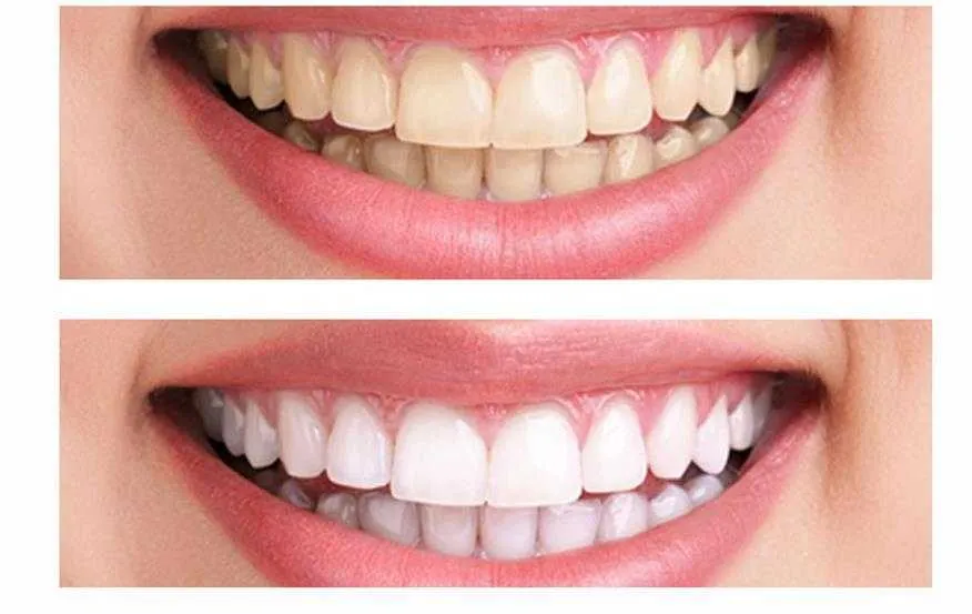29403 in office teeth whitening