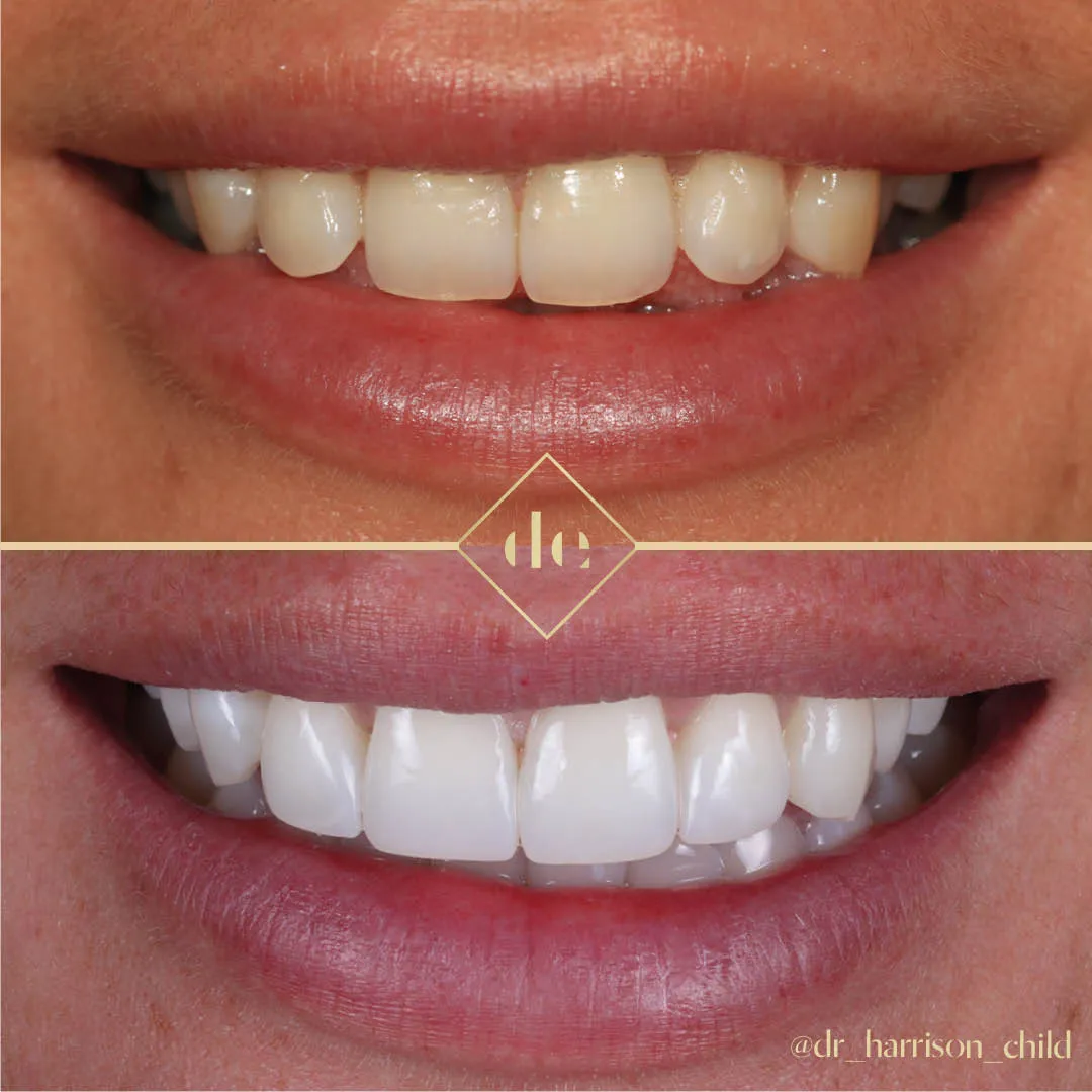 29403 teeth whitening cost factors