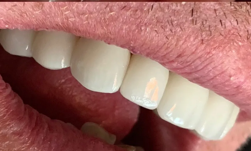 29405 at home teeth whitening kits