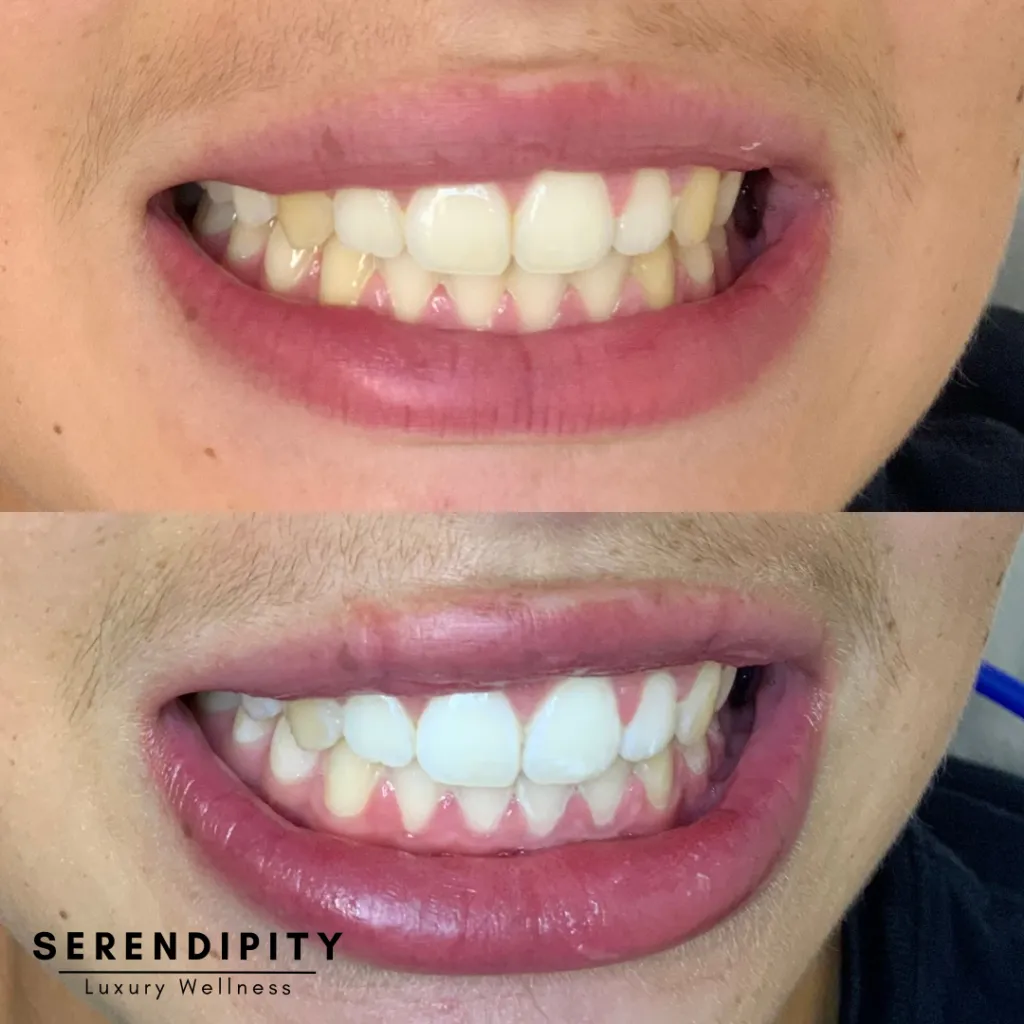 29405 teeth whitening comparison