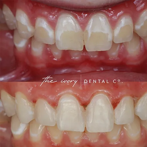 29407 at home whitening kit