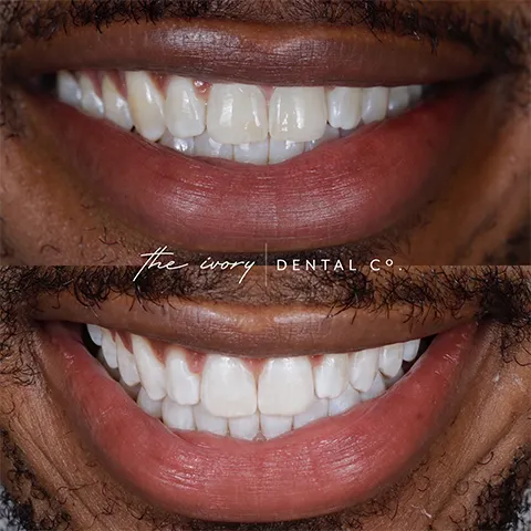 29407 in office whitening