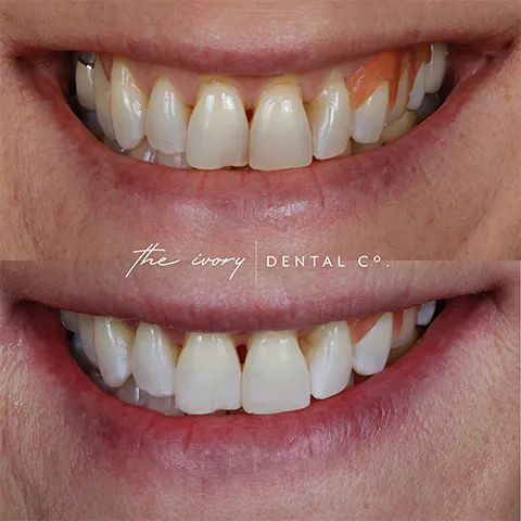 29407 professional teeth whitening