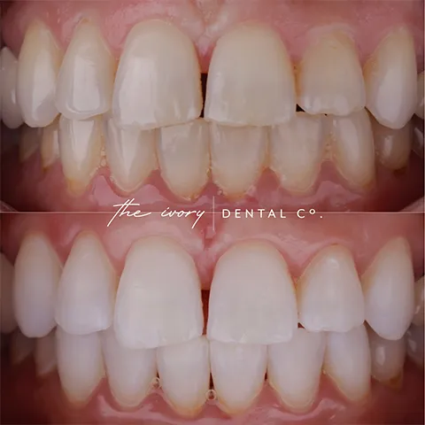 29407 teeth whitening food and drinks