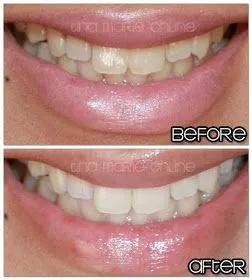 29410 teeth whitening comparison