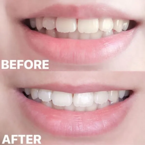 29413 flash teeth whitening cobbpkwy before after