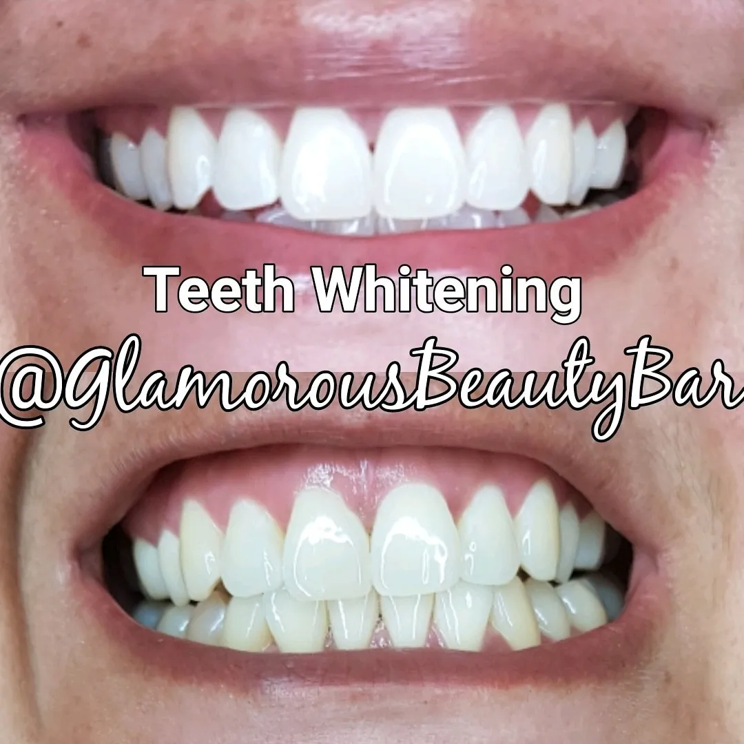 29413 flash teeth whitening cobbpkwy benefits