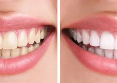 /img/29413-flash-teeth-whitening-cobbpkwy-happy-patient.webp