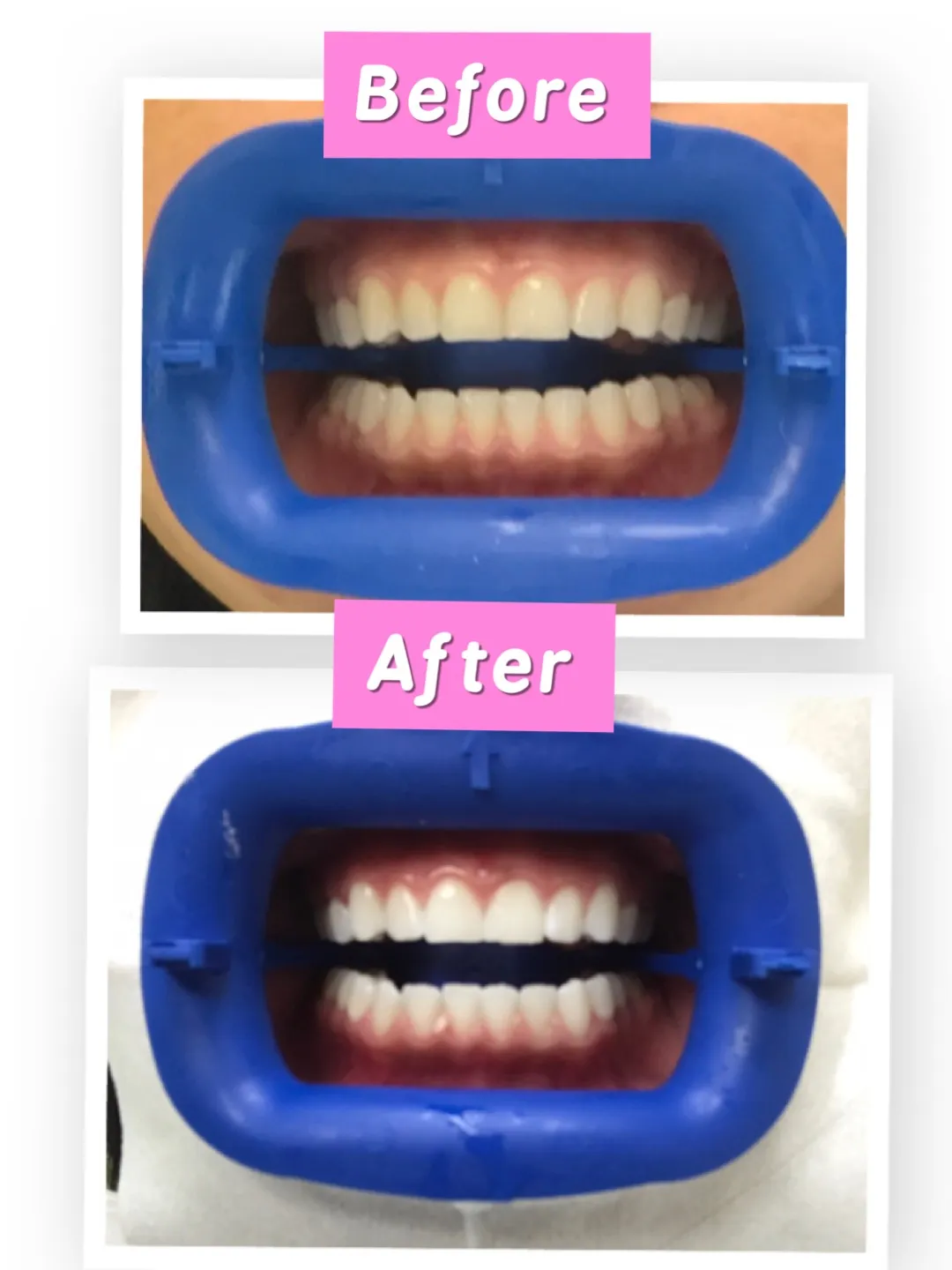 29413 flash teeth whitening cobbpkwy post care