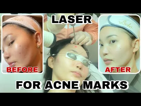 29414 belo angel laser before after