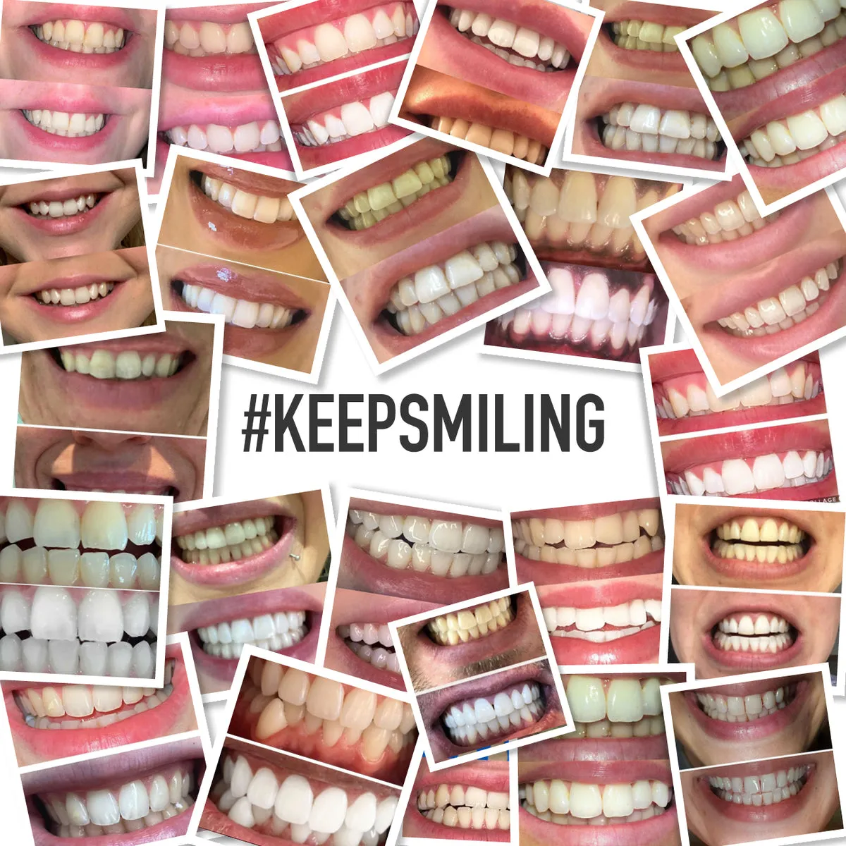 29416 at home teeth whitening