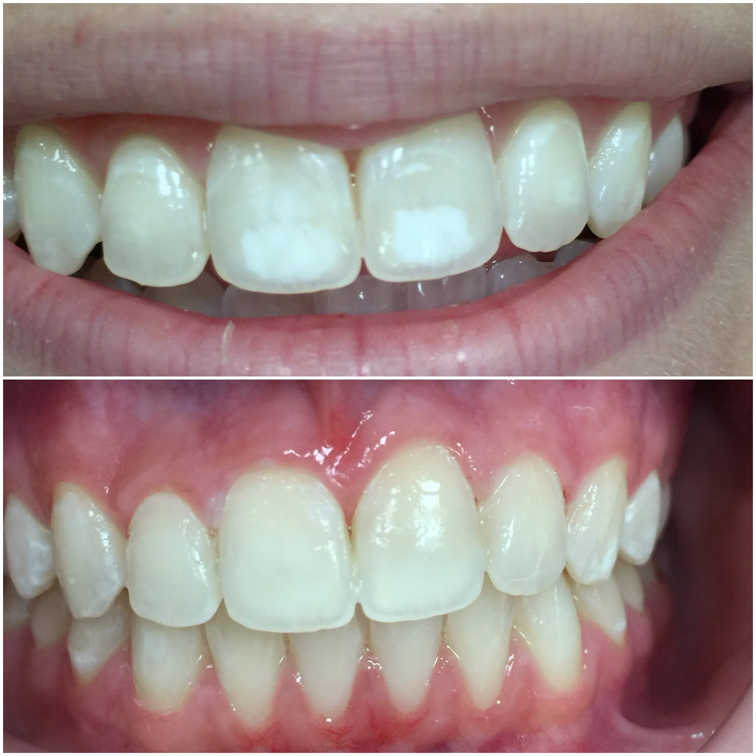 29419 enamel hypoplasia