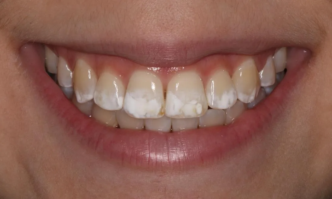 29419 fluorosis teeth