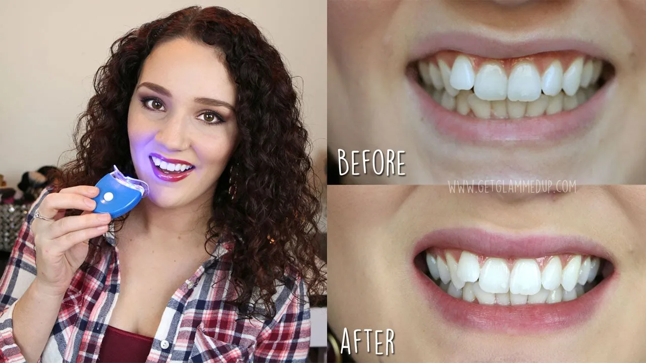 29420 teeth whitening aftercare