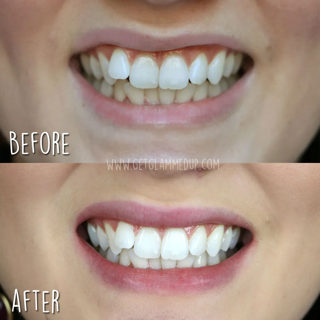 /img/29420-teeth-whitening-sensitivity.webp