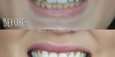 /img/29420-teeth-whitening-sensitivity.webp