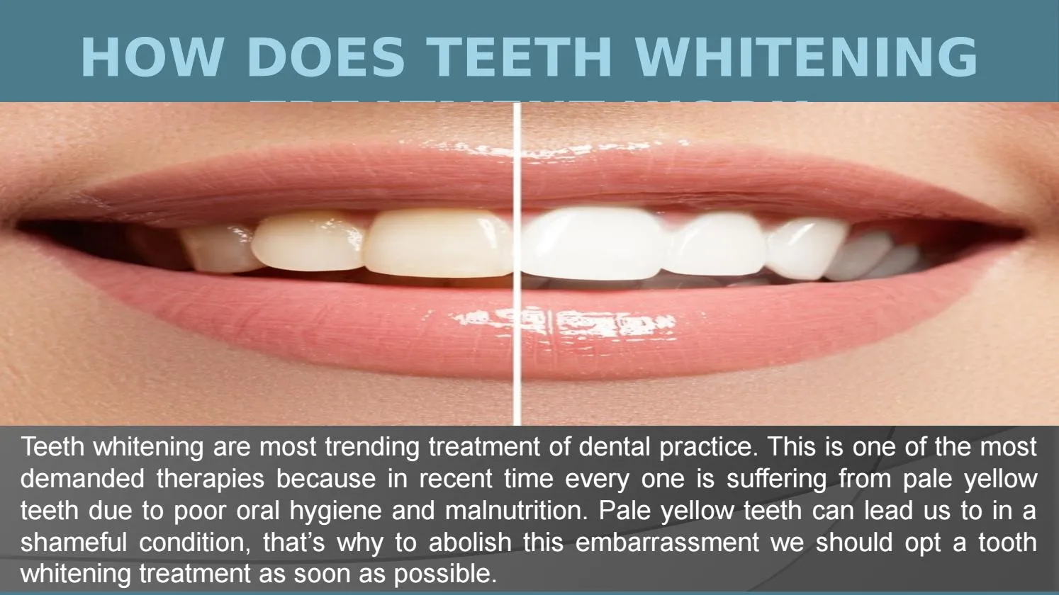 29421 in office teeth whitening