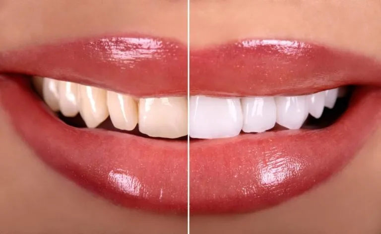 29423 professional whitening