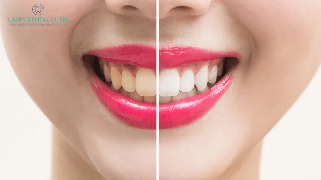 29424 over the counter teeth whitening