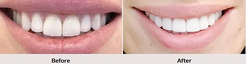 29424 teeth whitening los angeles maintenance